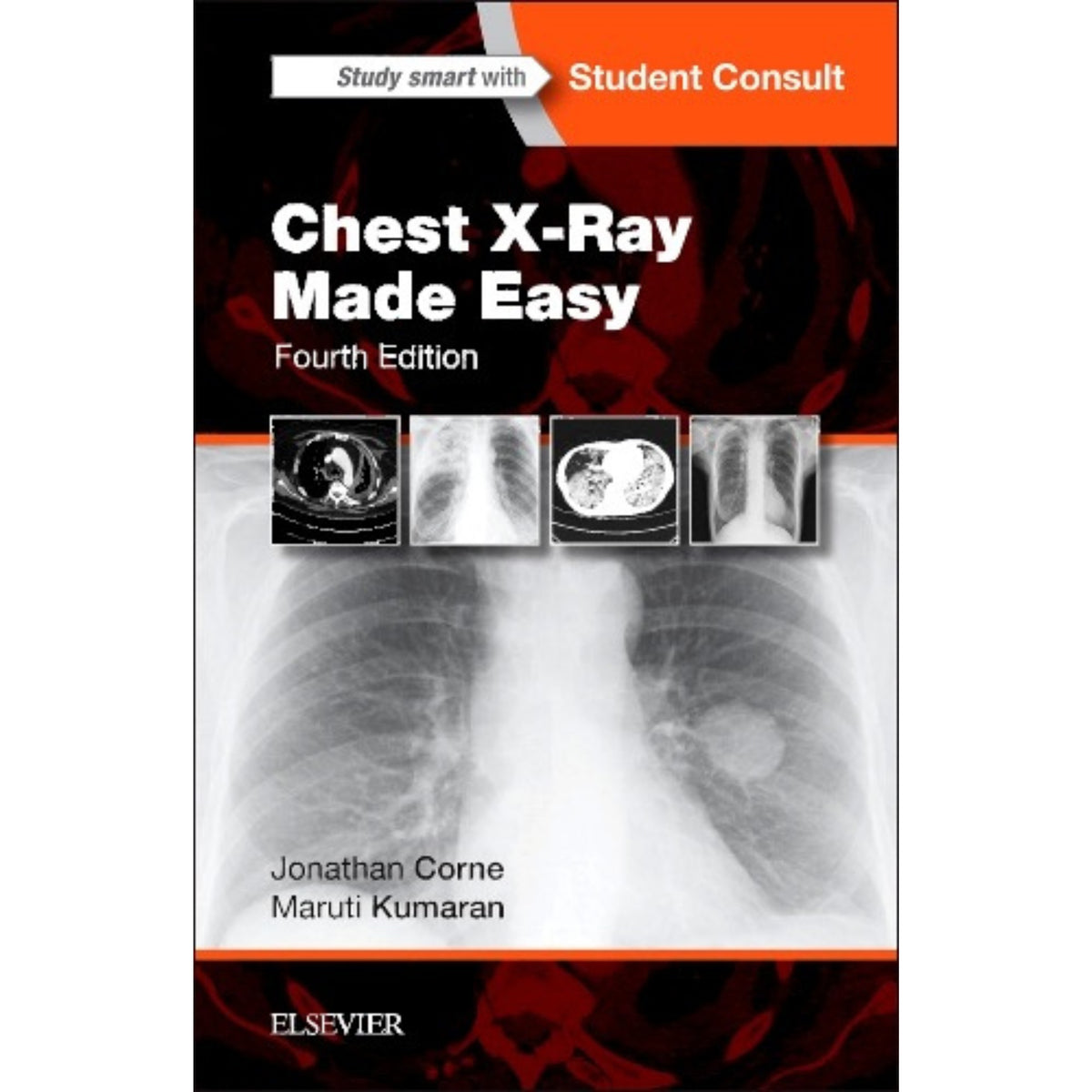 Chest Xray made easy