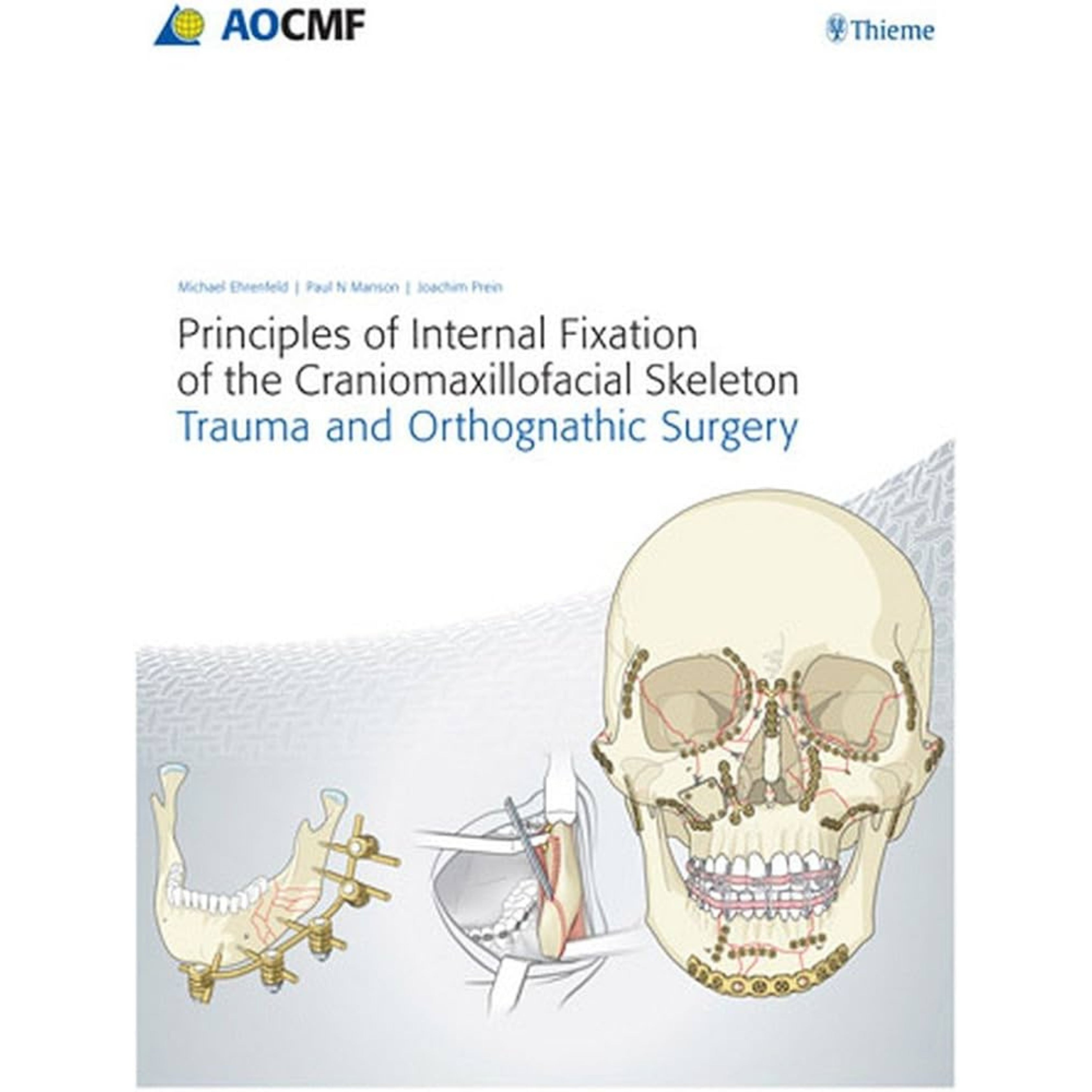 Principles of internal fixation of the craniomaxillofacial skeleton Trauma and orthognathic surgery